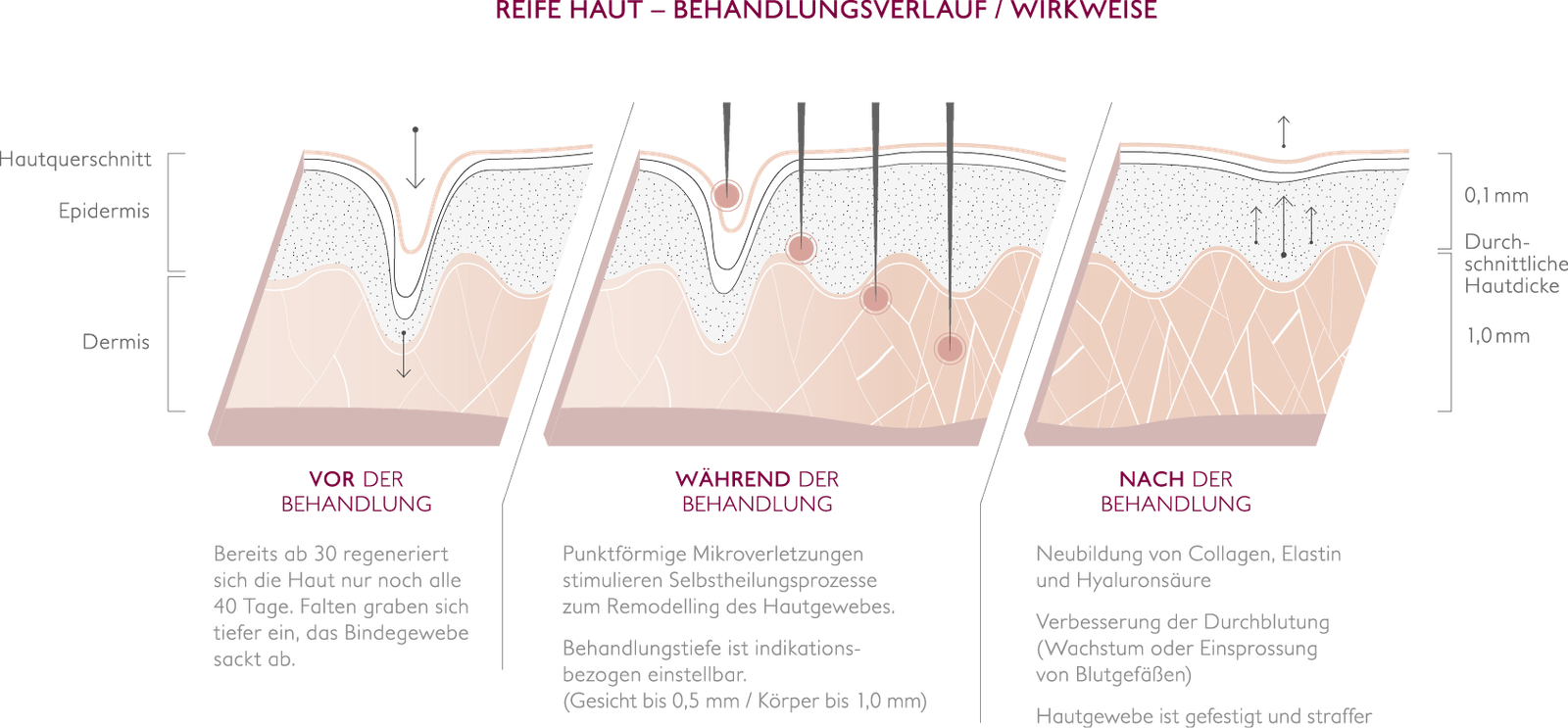 Querschnitt durch die Haut vor, während und nach dem Microneedling