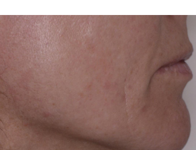 Wangenpartie nach sechs Microneedling-Behandlungen